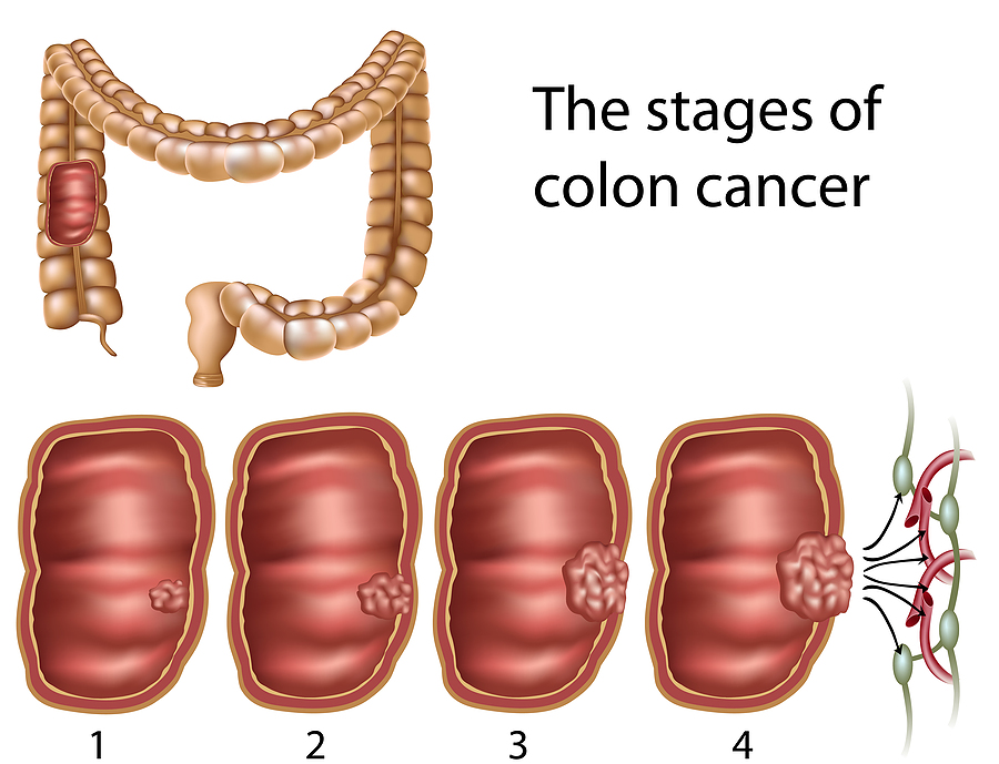 Etapas del cancer de colon